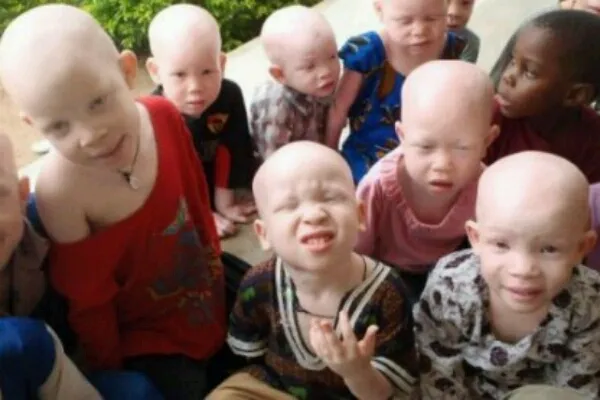 Albinos Tanzanie Enfants 1 Crop
